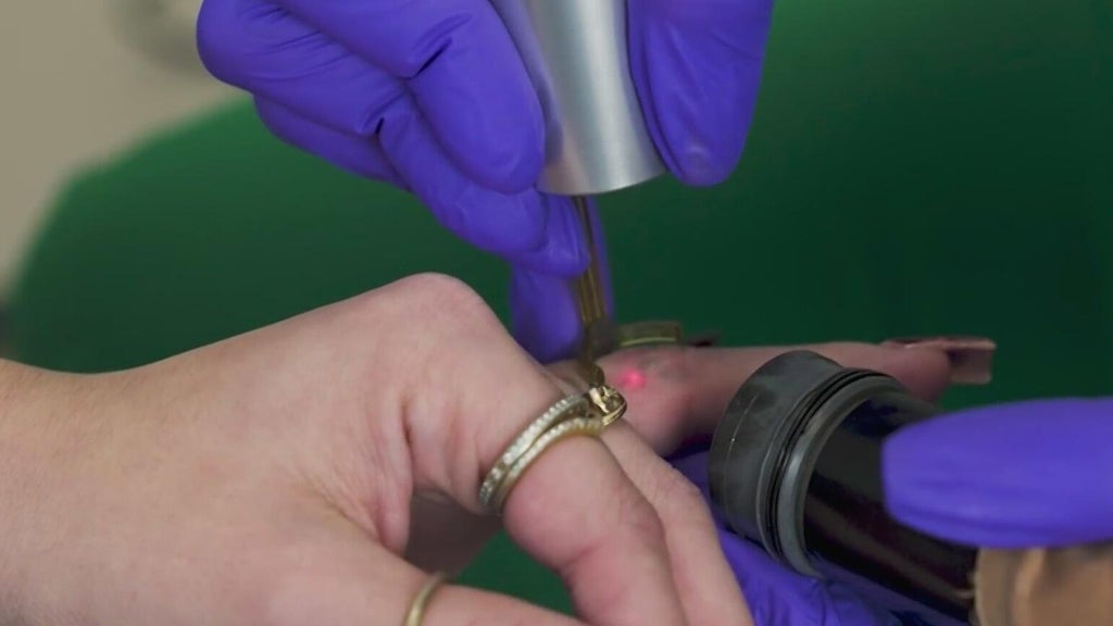 More South Florida tattoo clients are paying to get them removed — CBS Miami, Boca Raton Health news